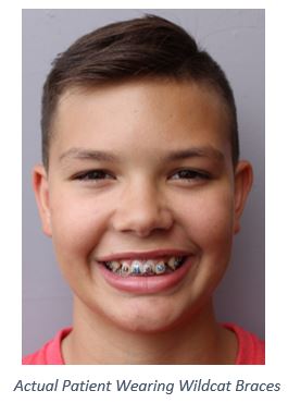 Wildcat Braces, Block A Braces, braces Tucson