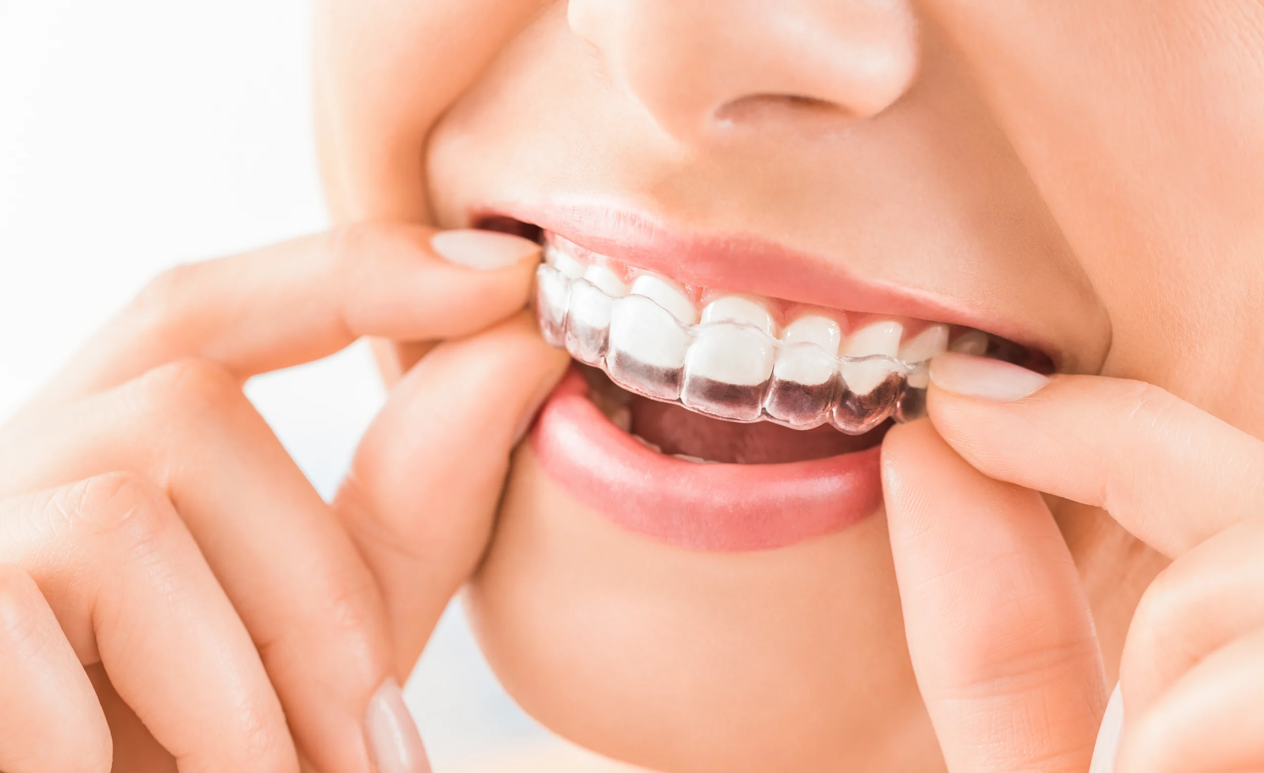 A smiling clear-aligner patient
